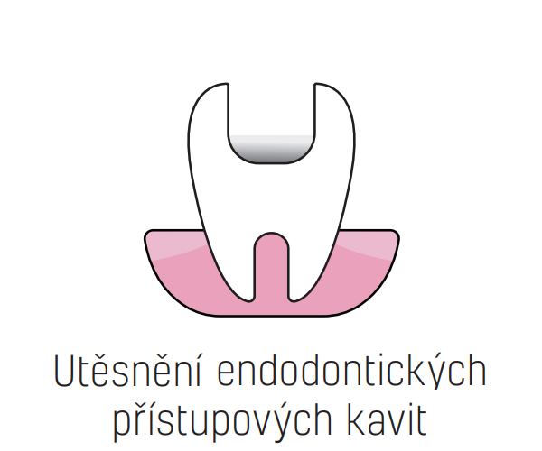 Utěsnění endodontických přístupových kavit